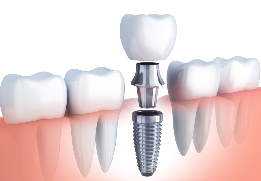 インプラントってなに？