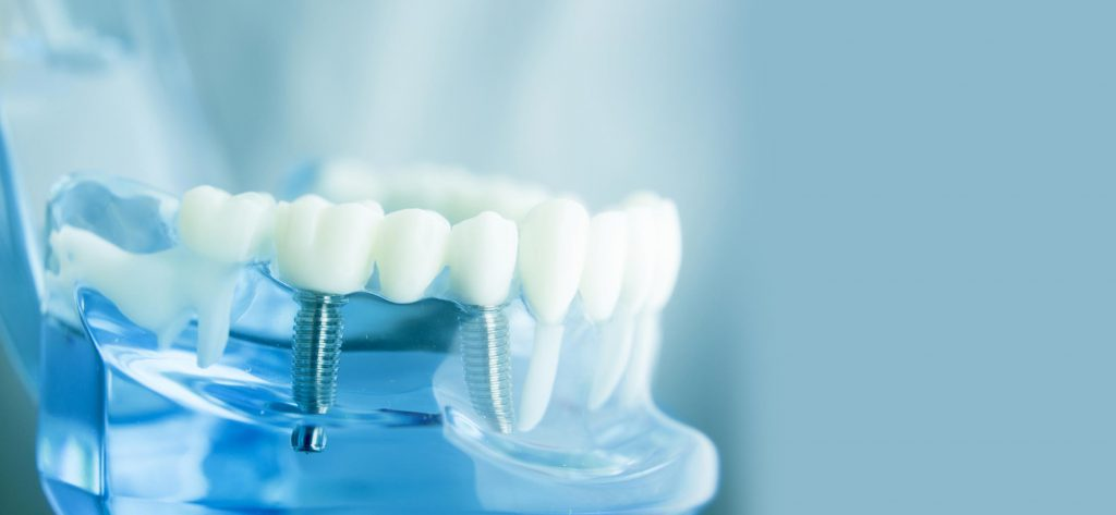 インプラント治療における歯医者の選び方