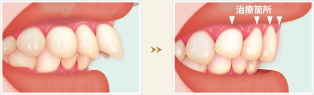 セラミック矯正ってなに？