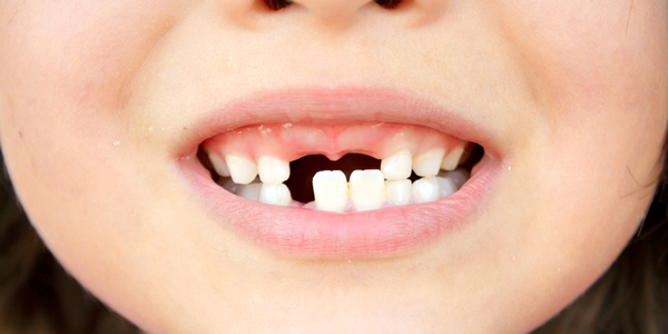 子供の歯の生え替わりについて