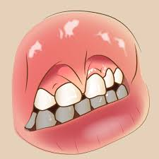 上唇小帯切除術　（上唇小帯ってなに？）