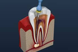根の治療とは？（根管治療ってなに？）