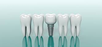 インプラントの治療の流れ（インプラントってどうやるの？）