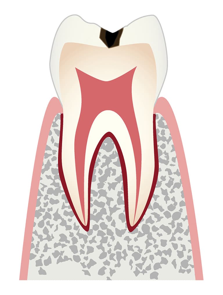 エナメル質に小さな穴が空いたむし歯のイラスト