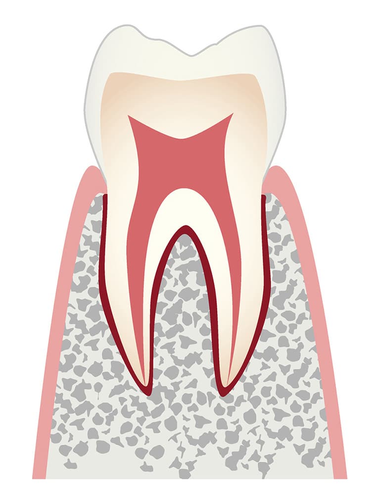 ごく初期のむし歯のイラスト
