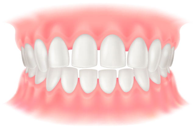 空隙歯列のイラスト