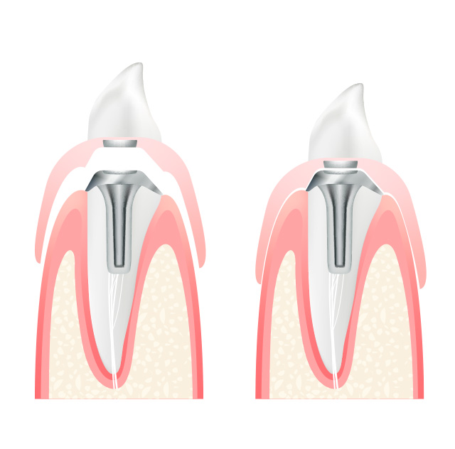 マグネットデンチャーのイラスト